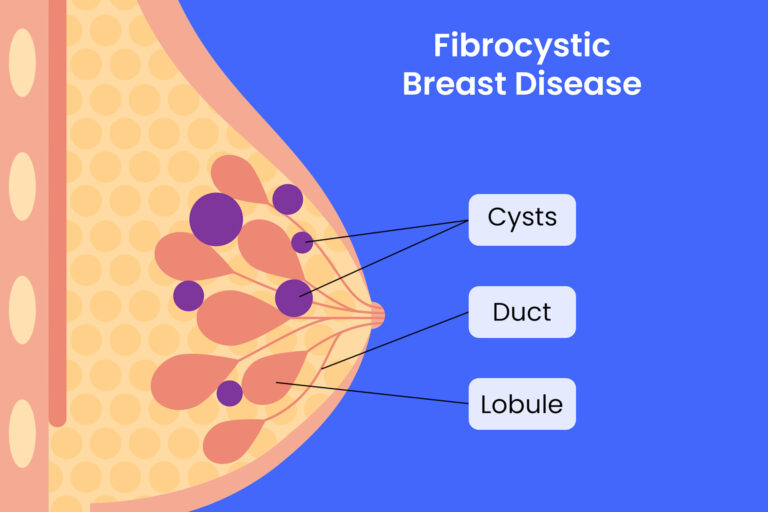Fibrocystic Breast Disease